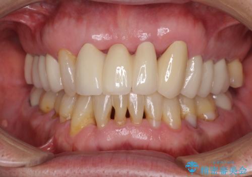 矯正治療と歯周外科処置を併用した審美歯科治療の症例 治療後