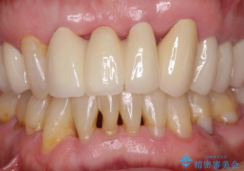 矯正治療と歯周外科処置を併用した審美歯科治療