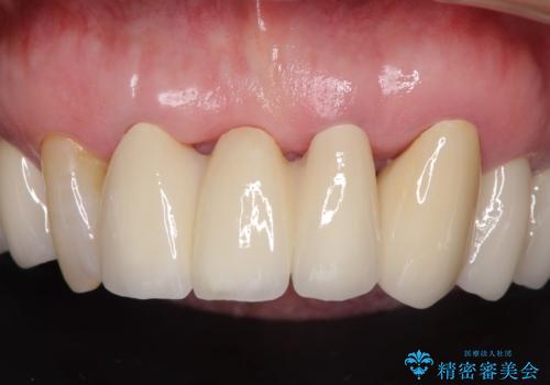 矯正治療と歯周外科処置を併用した審美歯科治療の治療後