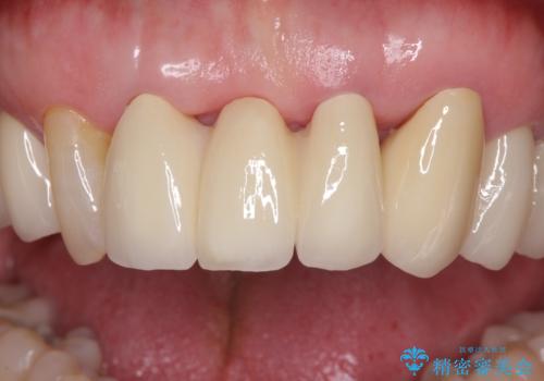 矯正治療と歯周外科処置を併用した審美歯科治療の治療後