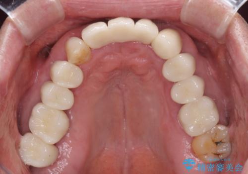 矯正治療と歯周外科処置を併用した審美歯科治療の治療後