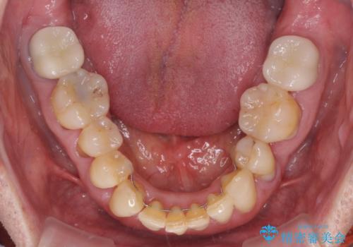 矯正治療と歯周外科処置を併用した審美歯科治療の治療後