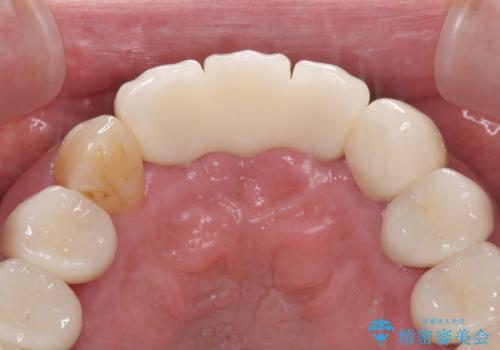 矯正治療と歯周外科処置を併用した審美歯科治療の治療後