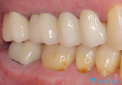 矯正治療と歯周外科処置を併用した審美歯科治療の治療後