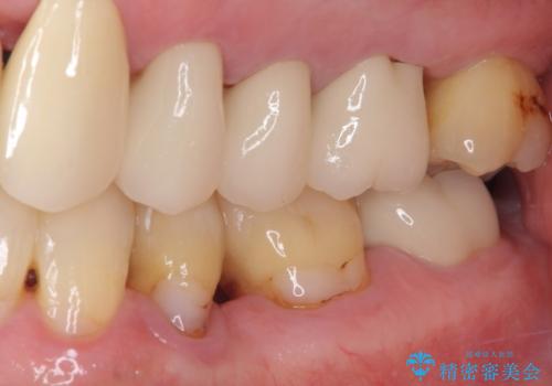 矯正治療と歯周外科処置を併用した審美歯科治療の治療後