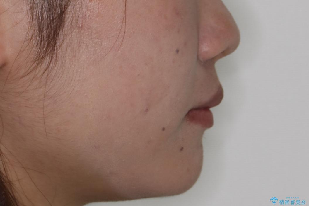 笑顔がきれいになった。抜歯矯正(審美装置)の治療前(顔貌)