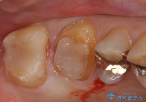 オールセラミッククラウン・セラミックインレー 歯茎より深い虫歯の治療の治療前