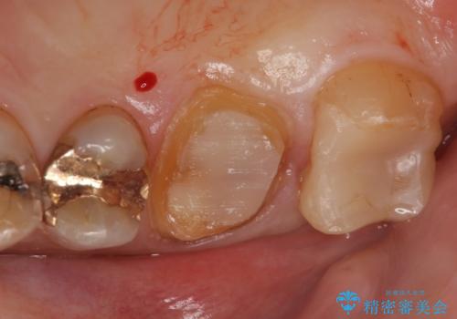 オールセラミッククラウン・セラミックインレー　歯茎より深い虫歯の治療の治療前