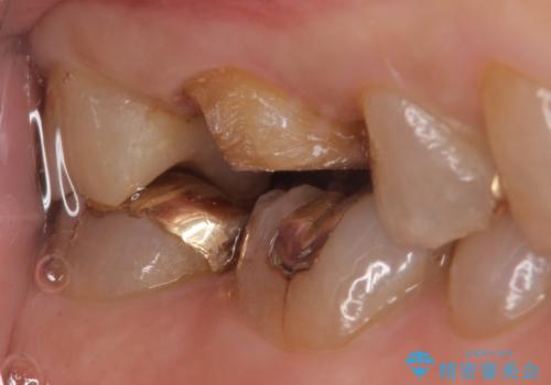 オールセラミッククラウン・セラミックインレー 歯茎より深い虫歯の治療の治療前