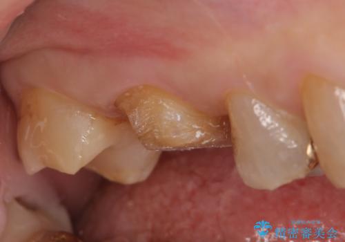 オールセラミッククラウン・セラミックインレー 歯茎より深い虫歯の治療の治療前