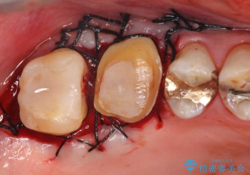 オールセラミッククラウン・セラミックインレー 歯茎より深い虫歯の治療の治療後