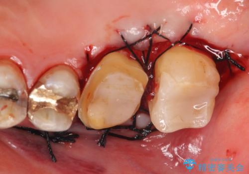 オールセラミッククラウン・セラミックインレー 歯茎より深い虫歯の治療の治療後
