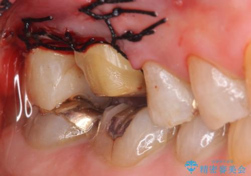 オールセラミッククラウン・セラミックインレー 歯茎より深い虫歯の治療の治療後