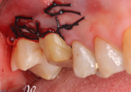 オールセラミッククラウン・セラミックインレー　歯茎より深い虫歯の治療の治療後