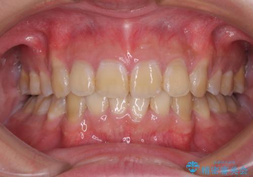 口元の突出感と叢生　ワイヤー装置による抜歯矯正