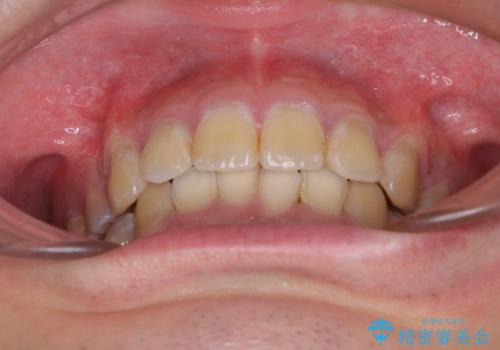 口元の突出感と叢生 ワイヤー装置による抜歯矯正の治療後