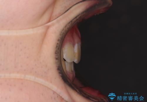 口元の突出感と叢生 ワイヤー装置による抜歯矯正の治療後