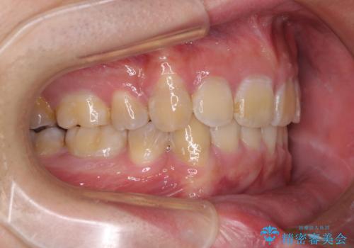 口元の突出感と叢生 ワイヤー装置による抜歯矯正の治療後