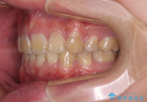 口元の突出感と叢生 ワイヤー装置による抜歯矯正の治療後