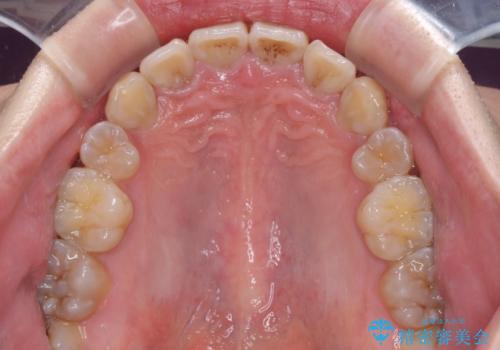 口元の突出感と叢生 ワイヤー装置による抜歯矯正の治療後