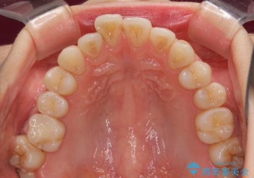 前歯のデコボコを治したい インビザラインによる矯正治療の治療前