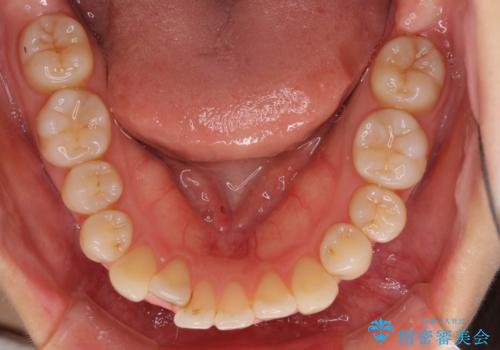 前歯のデコボコを治したい　インビザラインによる矯正治療の治療前