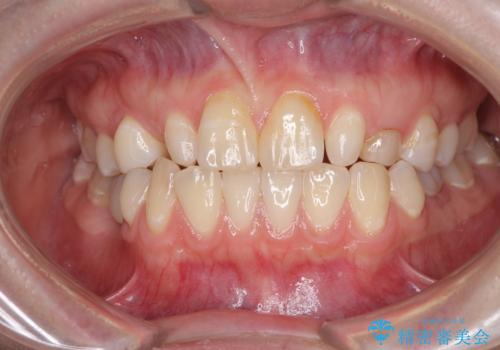 欠損と残存乳歯 矯正治療とインプラント治療の症例 治療前