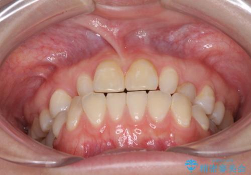 欠損と残存乳歯 矯正治療とインプラント治療の治療前