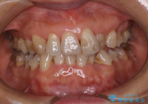 インビザライン中のクリーニングの治療前