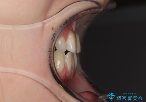 欠損と残存乳歯 矯正治療とインプラント治療の治療前