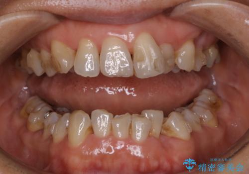 インビザライン中のクリーニングの治療前