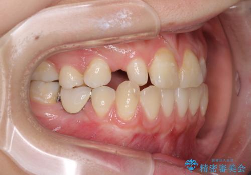 欠損と残存乳歯　矯正治療とインプラント治療の治療前