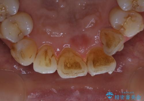 インビザライン中のクリーニングの治療前