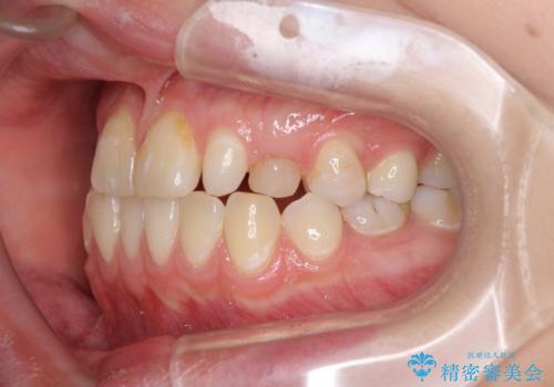 欠損と残存乳歯 矯正治療とインプラント治療の治療前