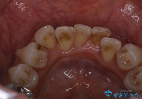 インビザライン中のクリーニングの治療前