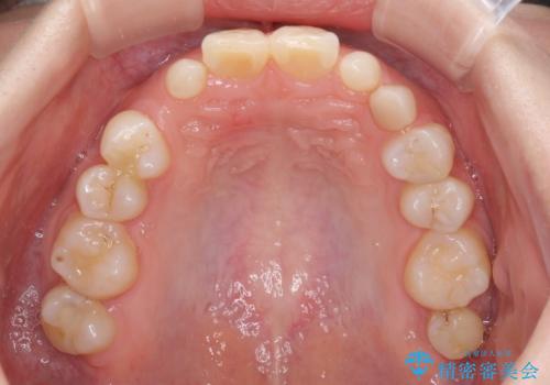 欠損と残存乳歯 矯正治療とインプラント治療の治療前