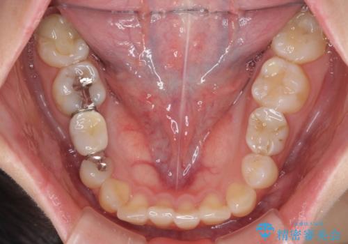 欠損と残存乳歯　矯正治療とインプラント治療の治療前