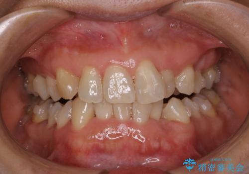 インビザライン中のクリーニングの治療後