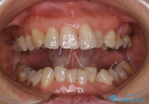 インビザライン中のクリーニングの治療後