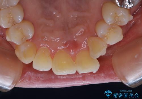 インビザライン中のクリーニングの治療後