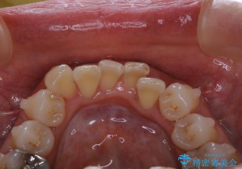 インビザライン中のクリーニングの治療後
