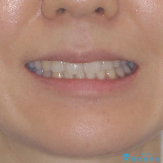 抜歯矯正の後戻り インビザラインによる再矯正治療の治療後(顔貌)