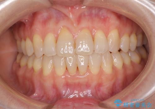 前歯の叢生と切端咬合　インビザラインによる矯正治療の治療中