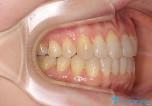 前歯の叢生と切端咬合 インビザラインによる矯正治療の治療中