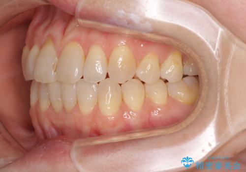 前歯の叢生と切端咬合 インビザラインによる矯正治療の治療中