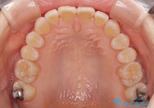 前歯の叢生と切端咬合 インビザラインによる矯正治療の治療中