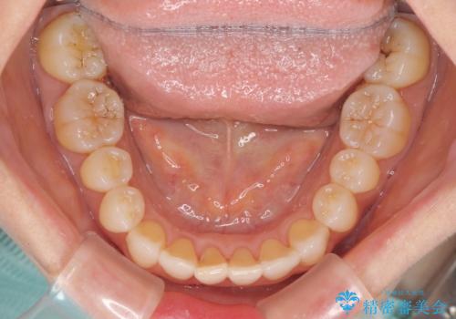 前歯の叢生と切端咬合　インビザラインによる矯正治療の治療中
