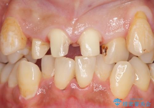 オールセラミッククラウン 長期間放置してきた前歯の虫歯治療の治療中
