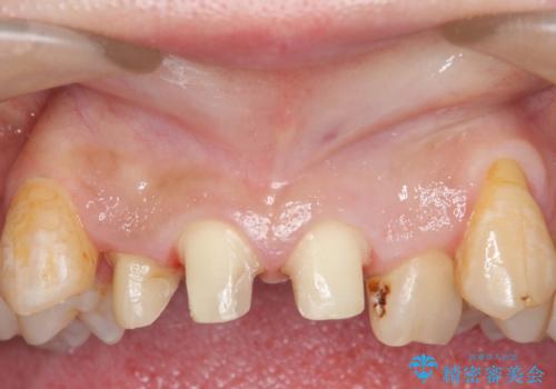 オールセラミッククラウン　長期間放置してきた前歯の虫歯治療の治療中