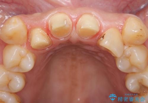 オールセラミッククラウン　長期間放置してきた前歯の虫歯治療の治療中